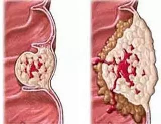 20年烟民咽喉发黑，瑞士专业医师推荐！一喷杀菌99.9%，止咳清痰排烟毒