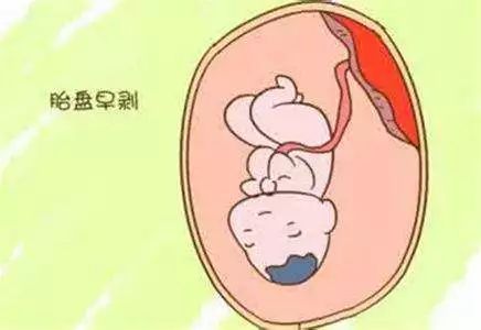 摔一跤会不会胎停,摔一跤会导致早产吗