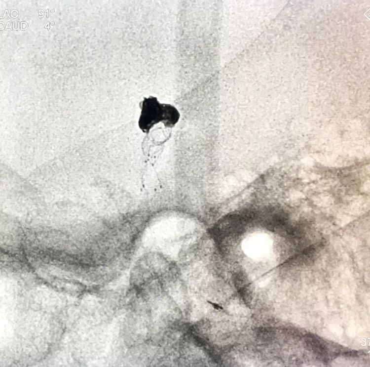 柳暗花明专栏|栓塞颅内动脉瘤时微导管无法穿过LVIS支架网眼怎么办