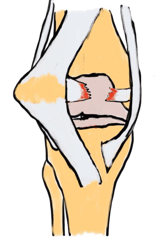 关节痛摔腿,关节弯曲痛打直就没事了