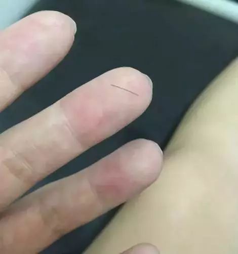 一根头发扎进皮肤里了,一根头发扎到皮肤