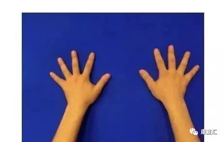 手指麻木刺痛,手指手术后麻木康复训练法