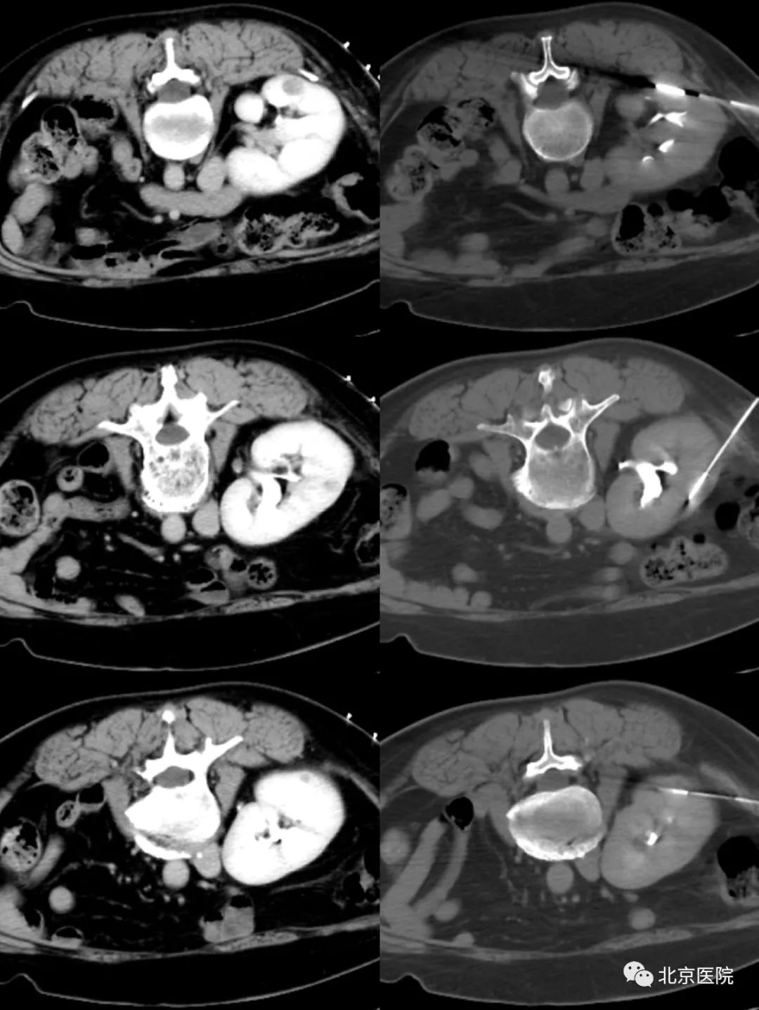 李晓光医生北京医院,北京医院肿瘤微创治疗中心李晓光
