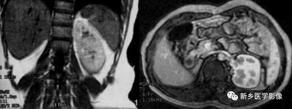肾脏疾病鉴别五项意义,肾脏病理分型及临床表现