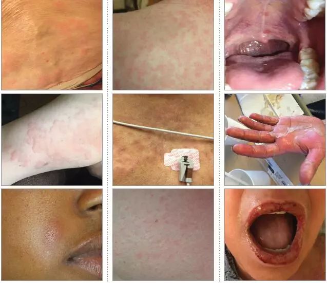 青霉素的过敏判断和处理,青霉素药物过敏实验报告