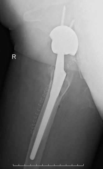 「筋骨堂」人工髋关节并非一劳永逸