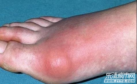 19岁男孩把饮料当水喝，结果脚痛到无法走路！爸爸惊呆……