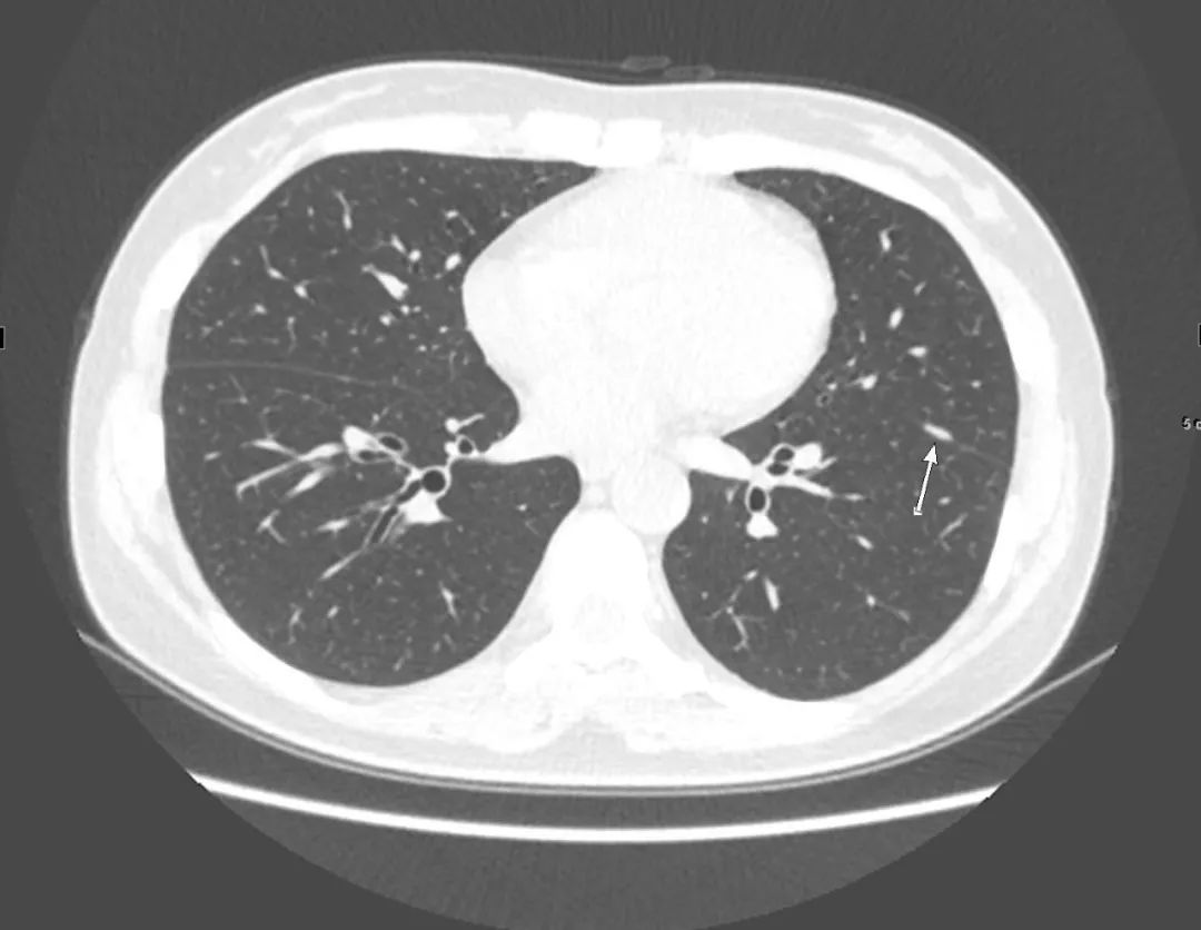 心冠动脉夹层能治愈吗,夹层动脉血管破裂症状