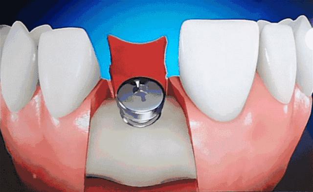 急急急！全城寻找缺牙、难看牙市民，每人最高获助20000元！