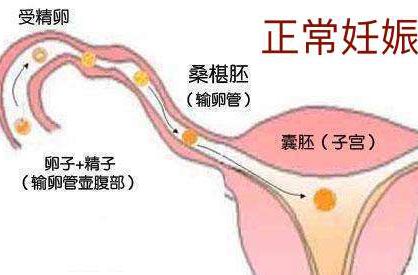 找错位置的受精卵——宫外孕