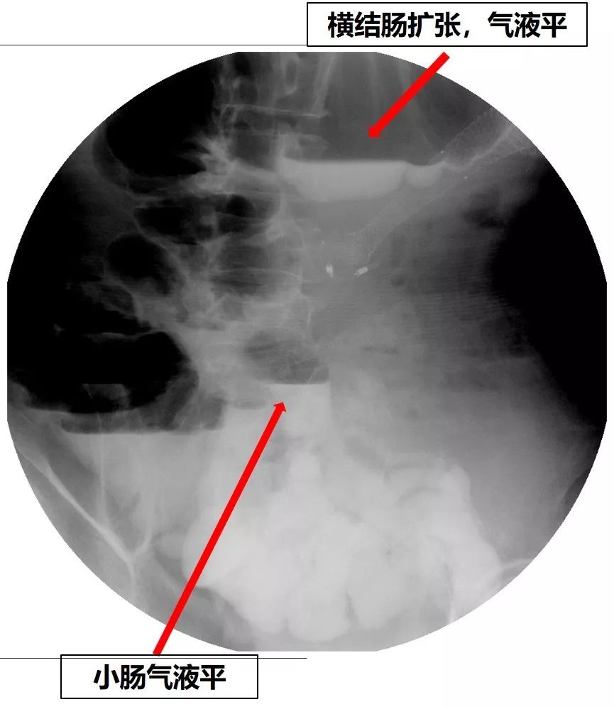 消化道支架置入术,消化道梗阻支架怎么放