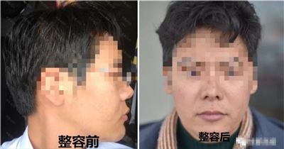 男子花10万隆鼻,男子花了一万块做眼鼻整形