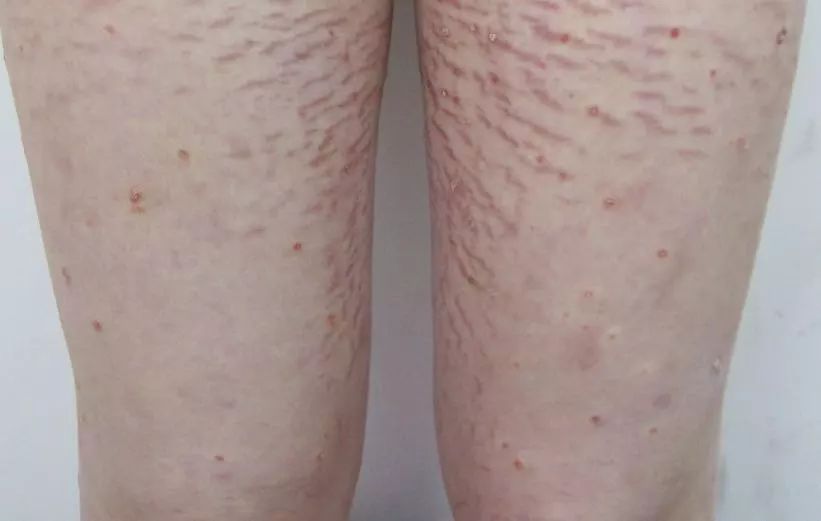 孩子身上长了一片褐色有毛斑点,小孩身上长褐色斑还有毛