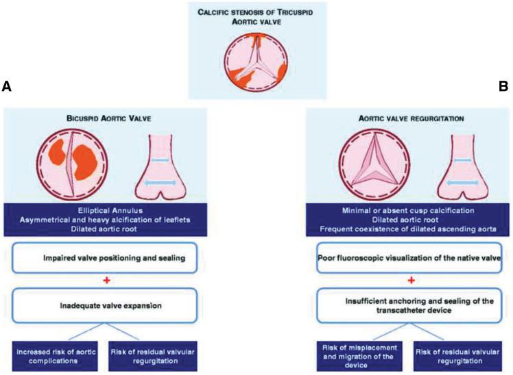 经导管瓣膜修复术费用,经导管瓣膜植入术风险