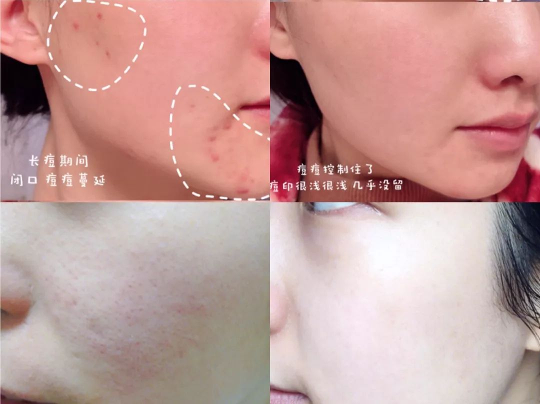 祛斑美白补水祛皱祛痘,祛斑祛痘美白改善暗沉