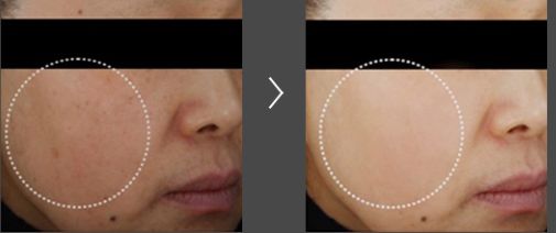 晒斑痘印去除土方法,5个祛斑小妙招淡化晒斑雀斑痘印