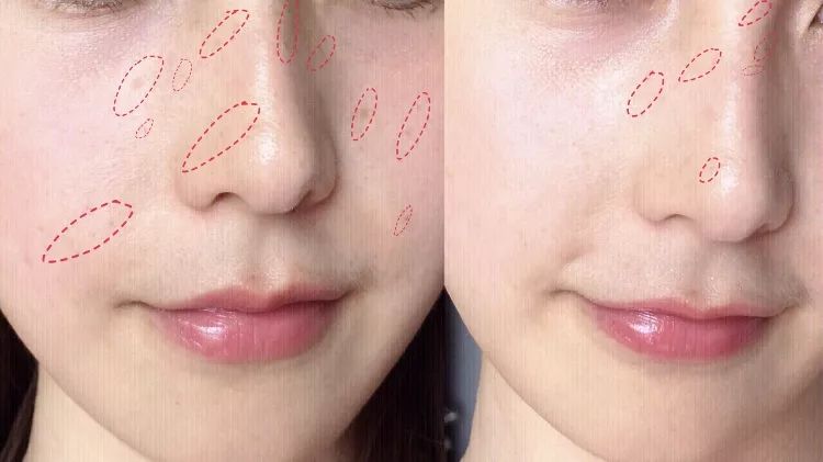 严重痘印晒斑,5个祛斑小妙招淡化晒斑雀斑痘印