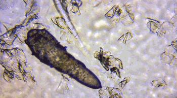 鼻头痘痘挤出来的白色物质是什么,团状红痘痘