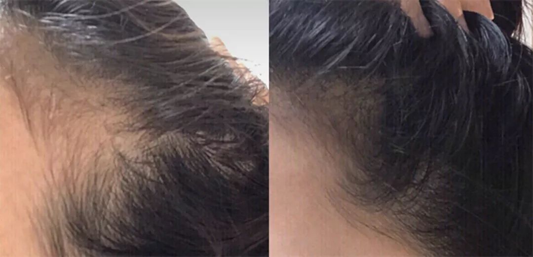 养发防脱拯救发际线洗发水,生发发际线的神器测评