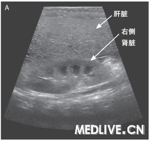 急性肝功能衰竭死亡病例,急性肝功能衰竭能彻底治好吗