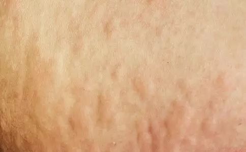 蚊虫叮咬脚气怎么办,超好用的止痒消肿的药膏蚊虫叮咬