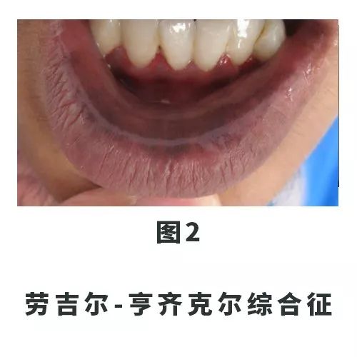 口唇有黑斑怎么消除,口唇上有黑斑是怎么回事