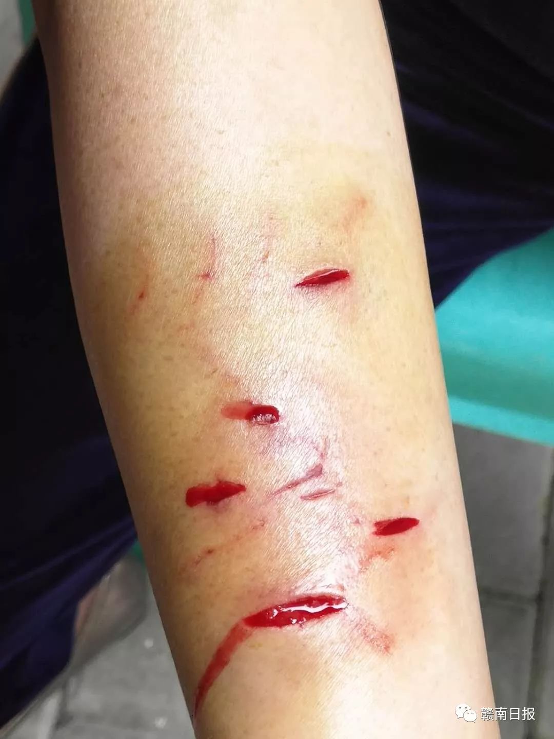 可怕疯狗咬伤多人警方紧急出动,疯狗咬伤6人