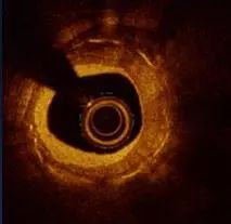 CIT2019｜李妍教授：OCT指导钙化病变，这些精髓要知道