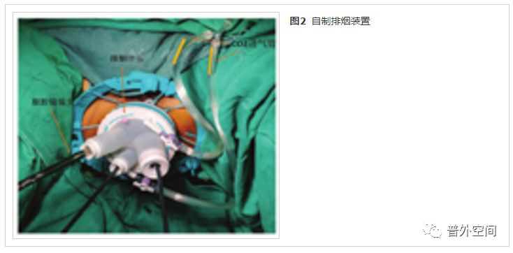 经肛直肠癌切除术,内镜下直肠切除术