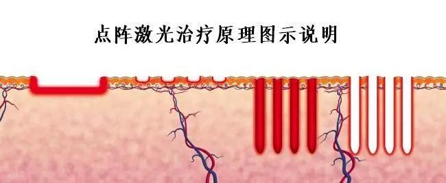 六大激光美容项目注意事项