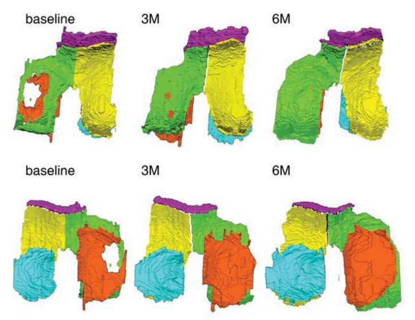 膝关节软骨退化干细胞治疗,间充质干细胞治疗膝关节