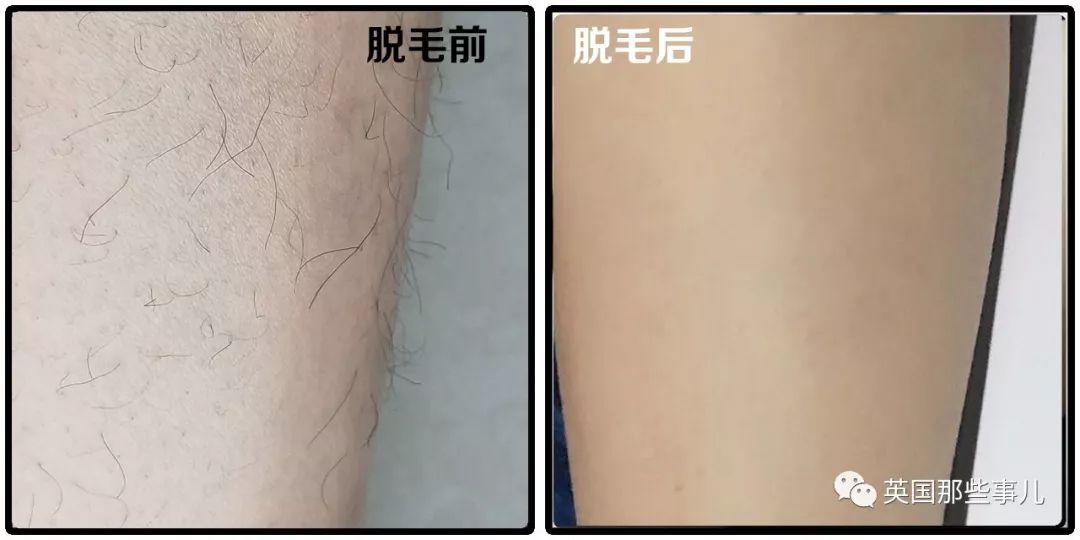 人类进化过程中体毛变少了,人类体毛为什么变少了