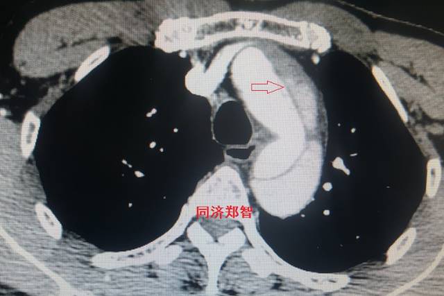 没有cta这三招也能识别主动脉夹层,磁共振可以替代cta检查主动脉夹层