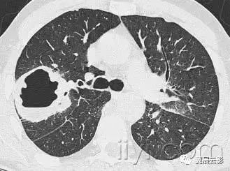 胸部解剖及常见疾病影像表现,胸部影像学基础知识