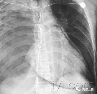 胸部解剖及常见疾病影像表现,胸部影像学基础知识
