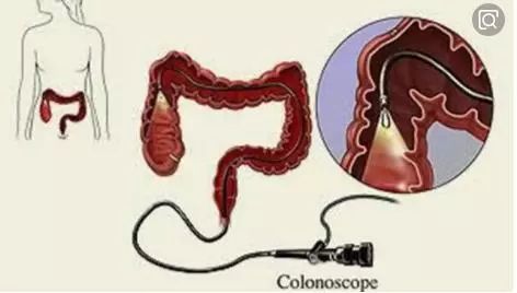 预防胃肠癌从做胃肠镜开始,胃肠镜检查早癌