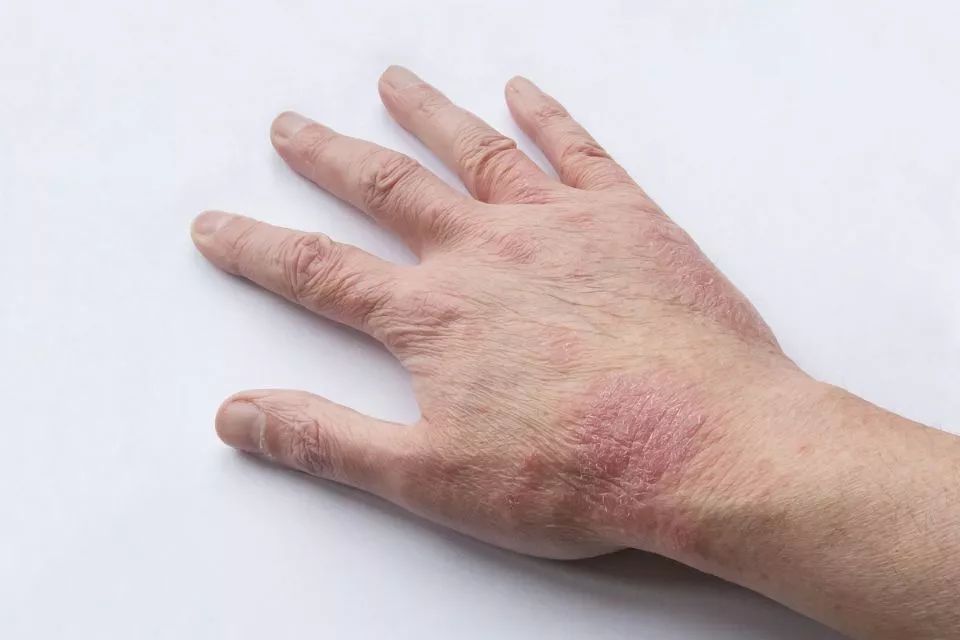 名医专栏|痒痒痒！皮痒怎么办？