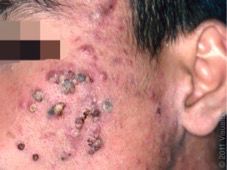 哪种皮肤病容易被误判为银屑病,容易被误诊为疥疮的皮肤病