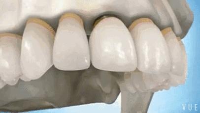 武汉种植牙齿需要多少钱,武汉种植牙齿一颗要多少钱