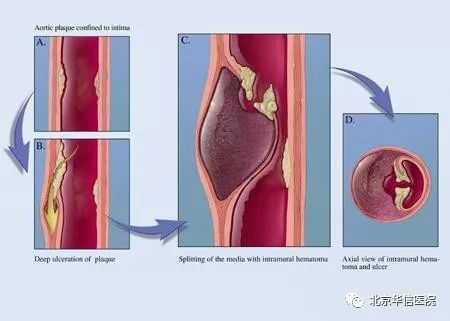 主动脉夹层最终是怎样致命的,主动脉夹层出院科普小知识