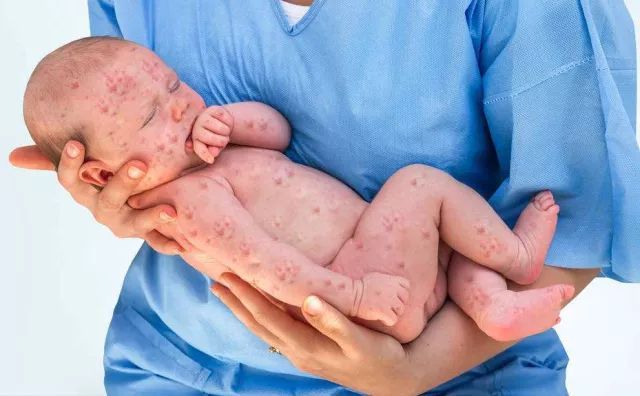 大人起水痘能死人吗,水痘造成多少人死亡