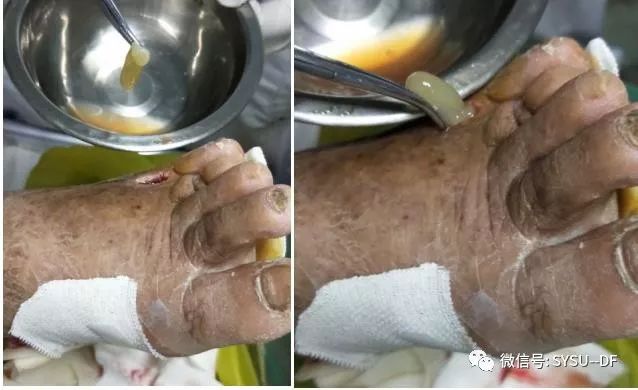 负压吸引糖尿病足的应用,负压滴灌治疗糖尿病足优势是什么