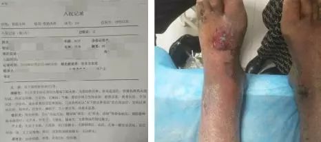 疮很常见，天疱疮你了解吗？