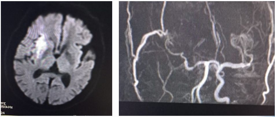 径技·例量|25期：再灌注出血—防不胜防