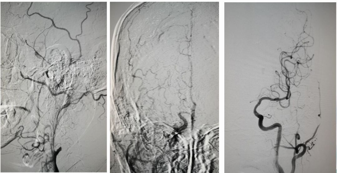 径技·例量|25期：再灌注出血—防不胜防