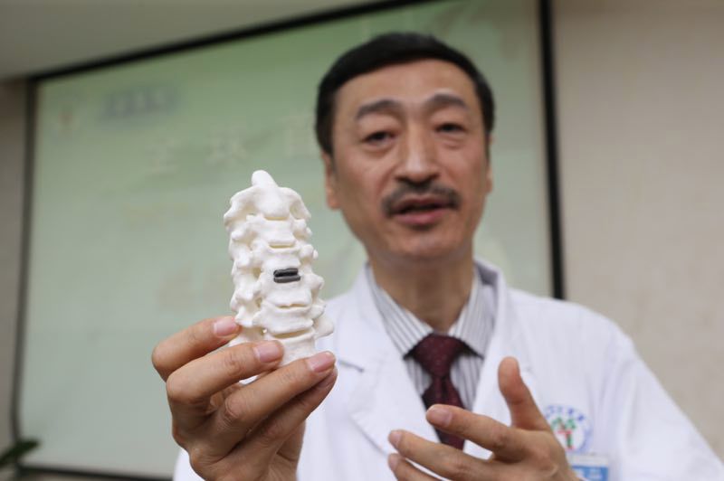 全球首例3D打印人体颈椎术，西安做到了！