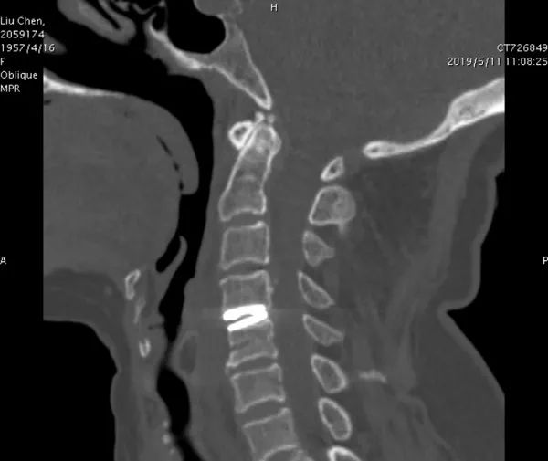 全球首例！西安3D打印人体颈椎术解决世界难题