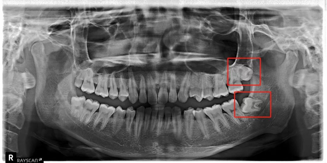 拔智齿注意事项漫画,漫画科普牙科