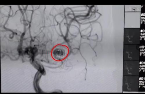 吉林省哪个医院做脑动脉瘤最好,吉林省神经精神病医院精神科