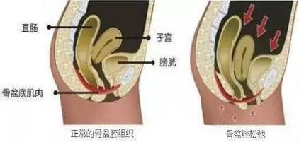 关爱女性盆底健康课程,关爱女性盆底健康讲座